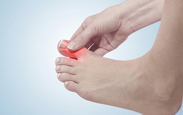Cao khô mật nhân giúp chữa bệnh gout